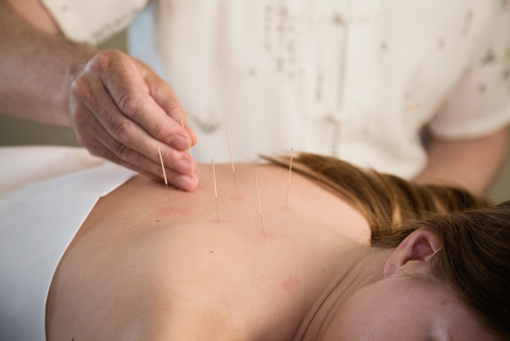 Akupunktur auf dem Rücken einer Patientin - Naturheilkunde - Immanuel Krankenhaus Berlin